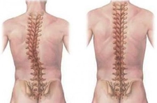 Omurga Çökmesi Belirtileri ve Tedavisi